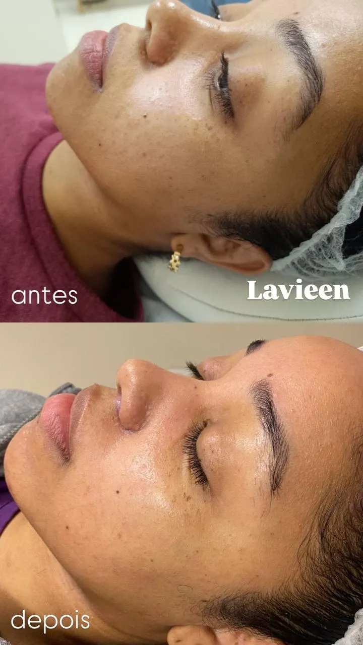antes_e_depois_lavieen_deise_esq_1x.webp