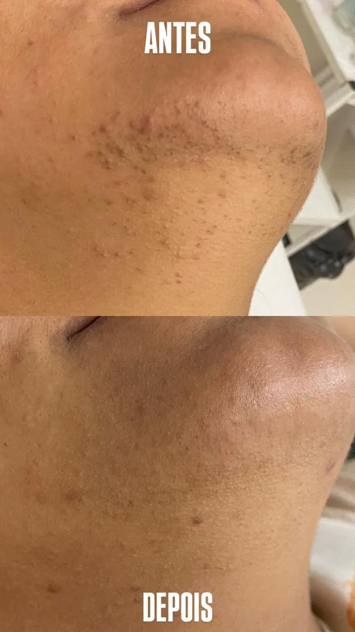 depila_o_a_laser_facial_1x.webp