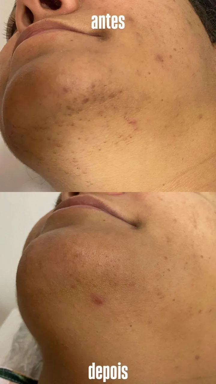 depila_o_a_laser_facial_2_1x.webp